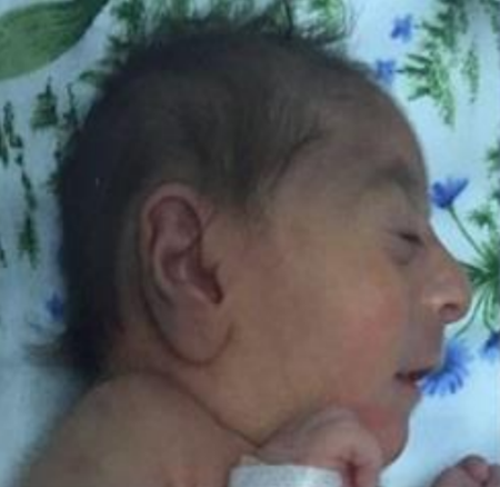 apple peel syndrome with microcephaly and ocular anomalies